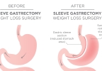 What is Gastric Sleeve surgery? 