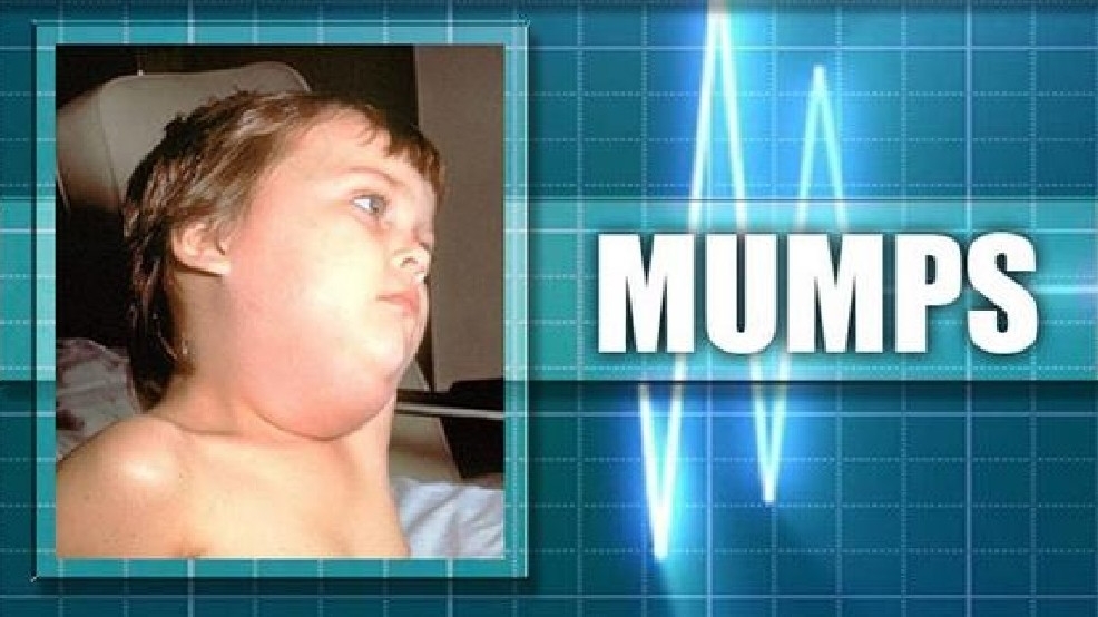 County Line Auto >> Common cold or a case of the mumps? Here's what symptoms ... County Line Auto >> Common cold or a case of the mumps? Here's what symptoms ...