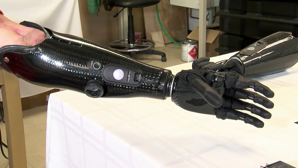 Bionic Arm Made By UI Alum Is Changing The World Of Prosthetics | WRSP